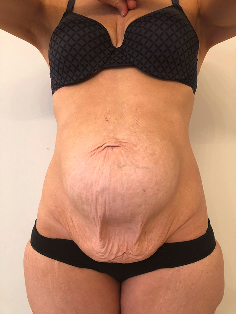 The Cosmetic Lane on X: An extreme case of Umbilical Hernia & severe Diastasis  Recti ✨ She's only 6 weeks post op  / X