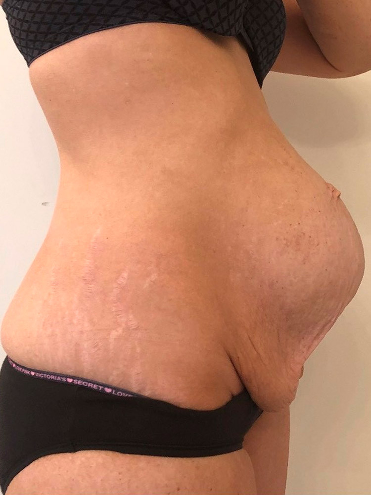 Body FX - Client has Diastasis Recti, also known as abdominal separation,  after her pregnancy. Sometimes depending on the degree of separation, you  will need therapy or surgery to repair the problem.